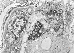type I membranoproliferative glomerulonephritis type I membranoproliferative glomerulonephritis